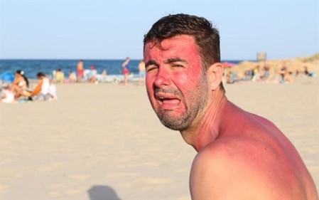 Red-faced man on beach from sunburn